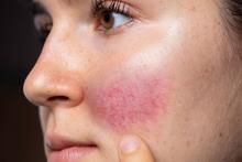 how-to-prevent-red-skin